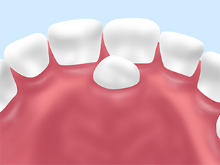 過剰歯（かじょうし）の抜歯