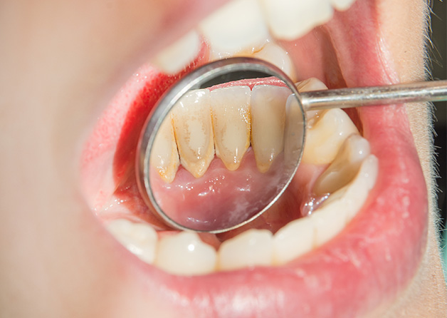 虫歯・歯周病を防げる