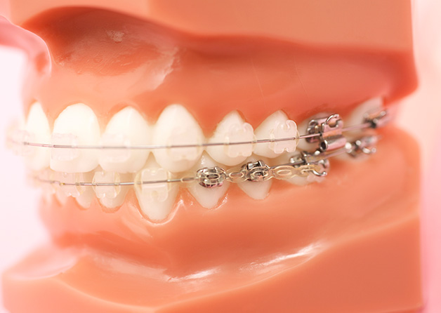 歯列矯正での第2期治療