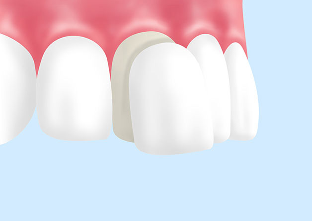 歯の欠け・すきっ歯をなおす「ラミネートベニア」